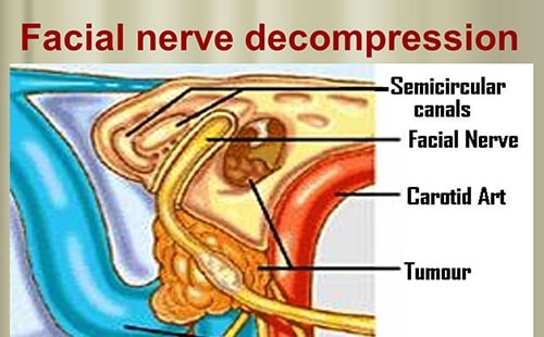 Facial Nerve Decompression